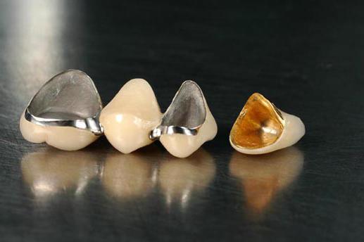Metallikeraamiset hampaat. Prosthetic hammaslääketiede: kermetit