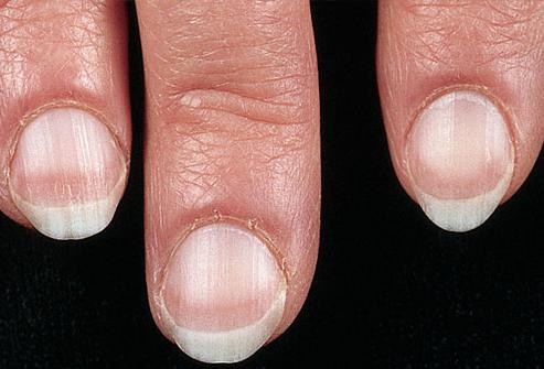 Ovatko kynsien sairaudet vaarallisia käsissä?